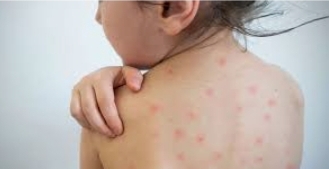 دستورالعملی برای دز تکمیلی یا یادآور واکسن MMR دریافت نکرده ایم/ والدین به علائم پوستی و تب حساس باشند