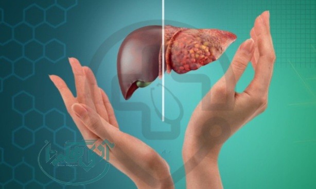 مراقب باشیم بیماری کبد چرب به مرحله نارسایی کبد نرسد