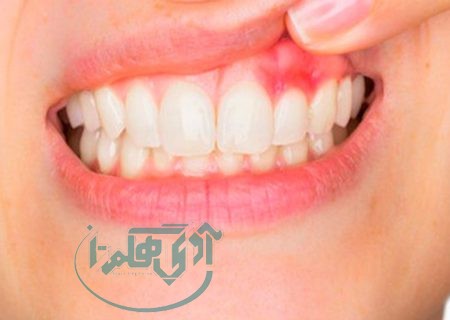 رعایت بهداشت دهان و دندان مؤثر در پیشگیری از بیماری‌ ژینژیویت