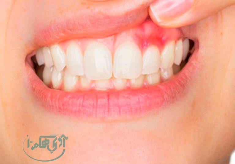 رعایت بهداشت دهان و دندان مؤثر در پیشگیری از بیماری ژینژیویت
