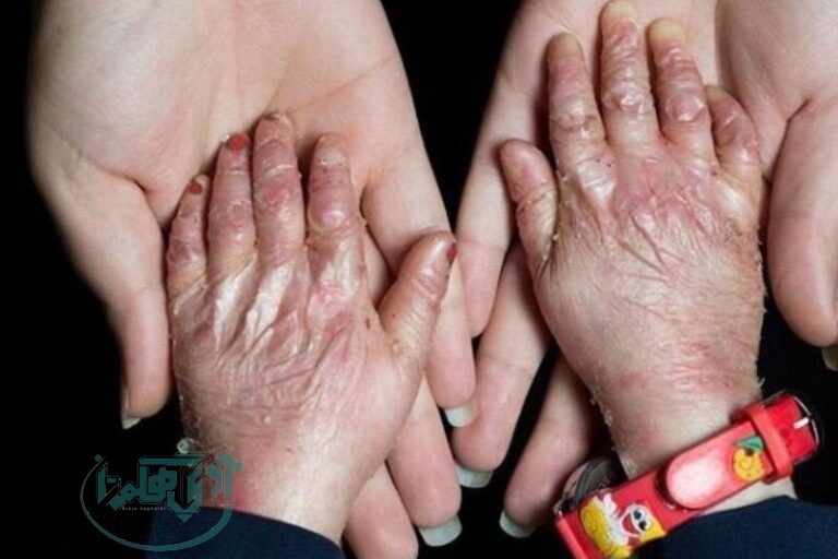 تشریح مراقبت‌ها و روش‌های درمان حمایتی در بیماران مبتلا به بیماری پروانه‌ای (EB)