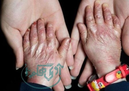 حمایت مستمر از بیماران اوتیسم، پروانه‌ای و پی‌کی‌یو در شهرستان اسدآباد