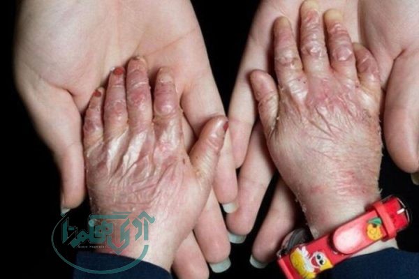 حمایت مستمر از بیماران اوتیسم، پروانه‌ای و پی‌کی‌یو در شهرستان اسدآباد